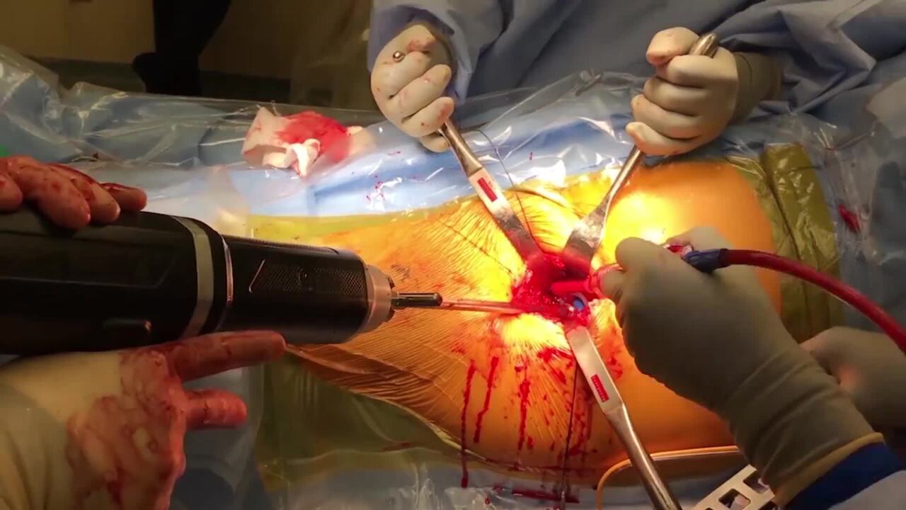 Dr Charles DeCook Hip Procedure Video 