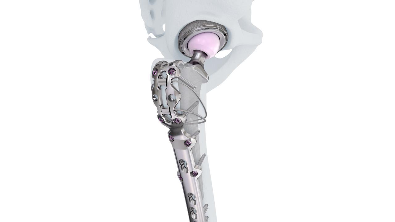 VA LCP™ Periprosthetic Proximal Femur Plating System​