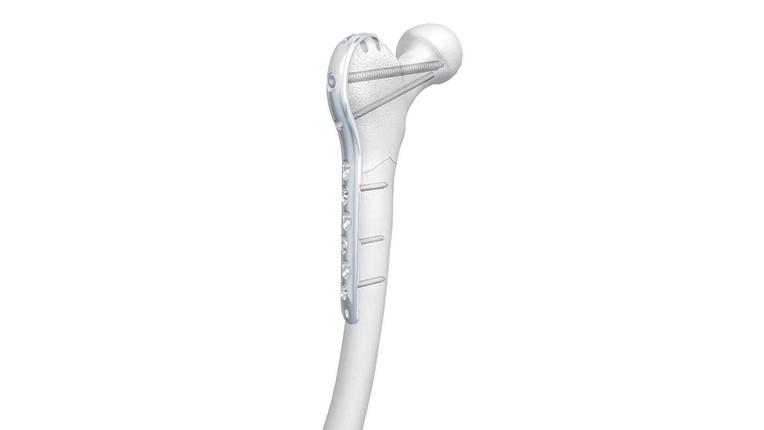 LCP Proximal Femur Hook Plate shown attached to bone with screws