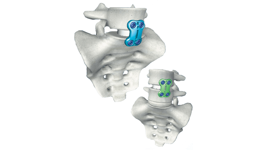 The ANTEGRA Plate System implants shown affixed to the lumbosacral spine