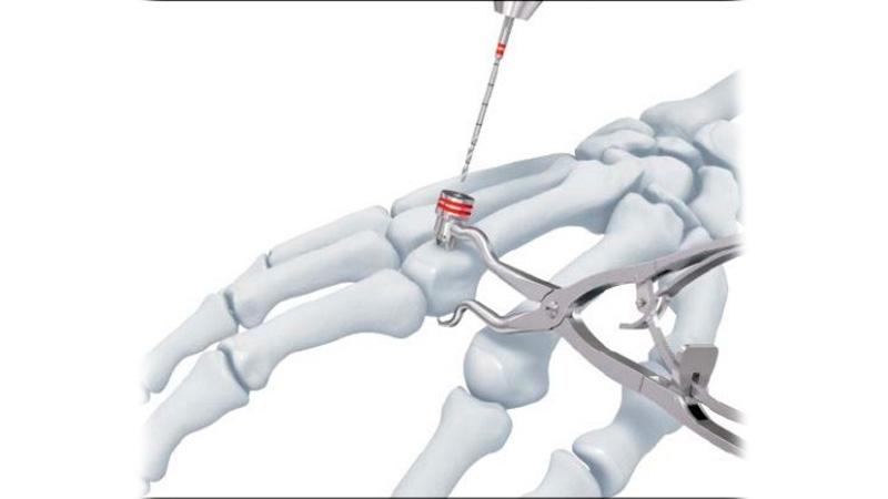 Lag screw inserted into the hand using drill sleeve