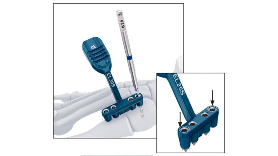 BME ELITE Drill Guide kit used to determine drill holes for hallux valgus deformity correction
