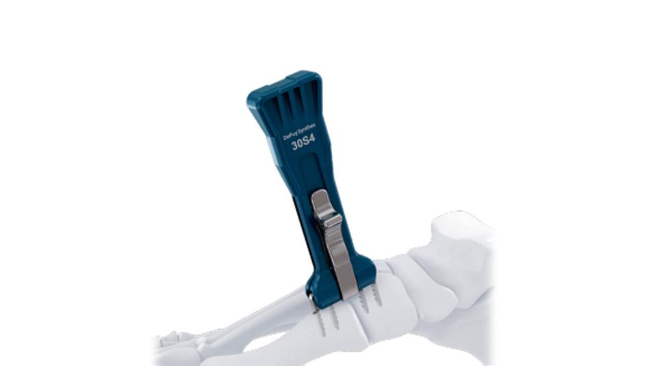 BME ELITE Implant inserted into drill holes using insertion tool for hallux valgus deformity correction.