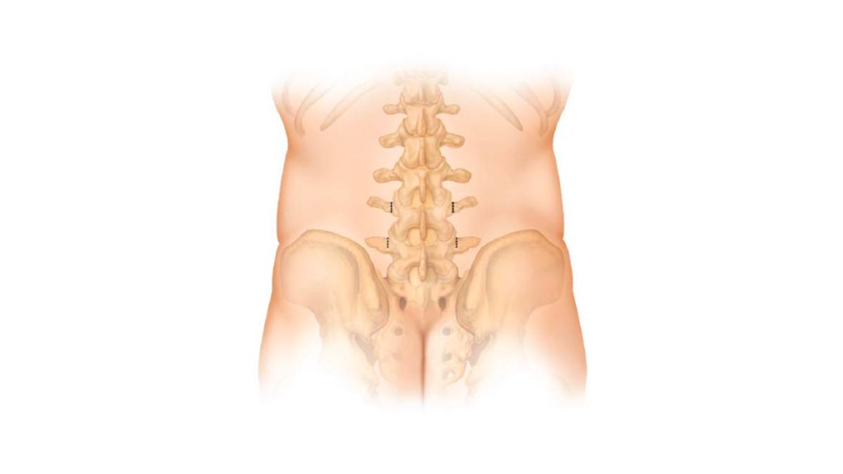 VIPER PRIME™ System for Percutaneous Pedicle Screw Placement