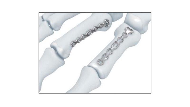 Variable Angle Locking Hand System Phalangeal Base Plate placement on hand