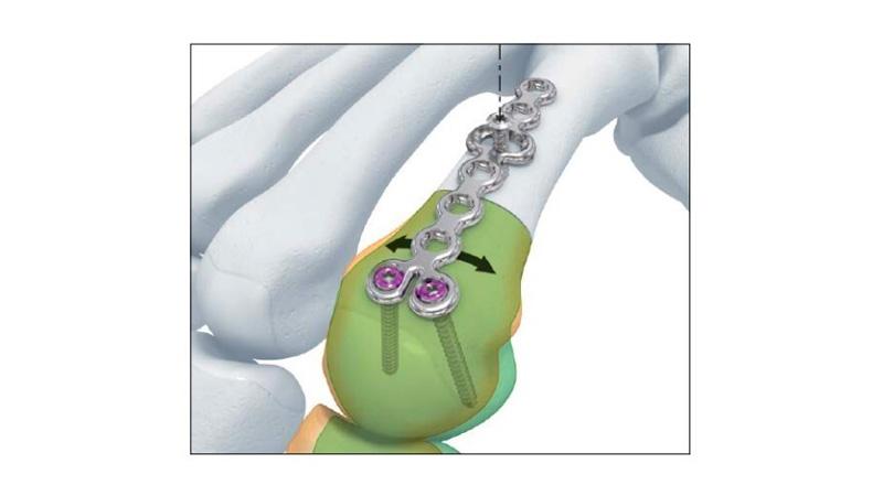 Variable Angle Locking Hand System Rotation Correction Plate screw placement in hand with plate adjustment options shown