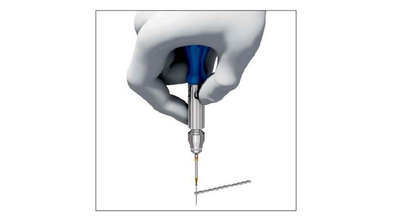 Variable Angle Locking Hand System screw insertion using two-finger tightening technique