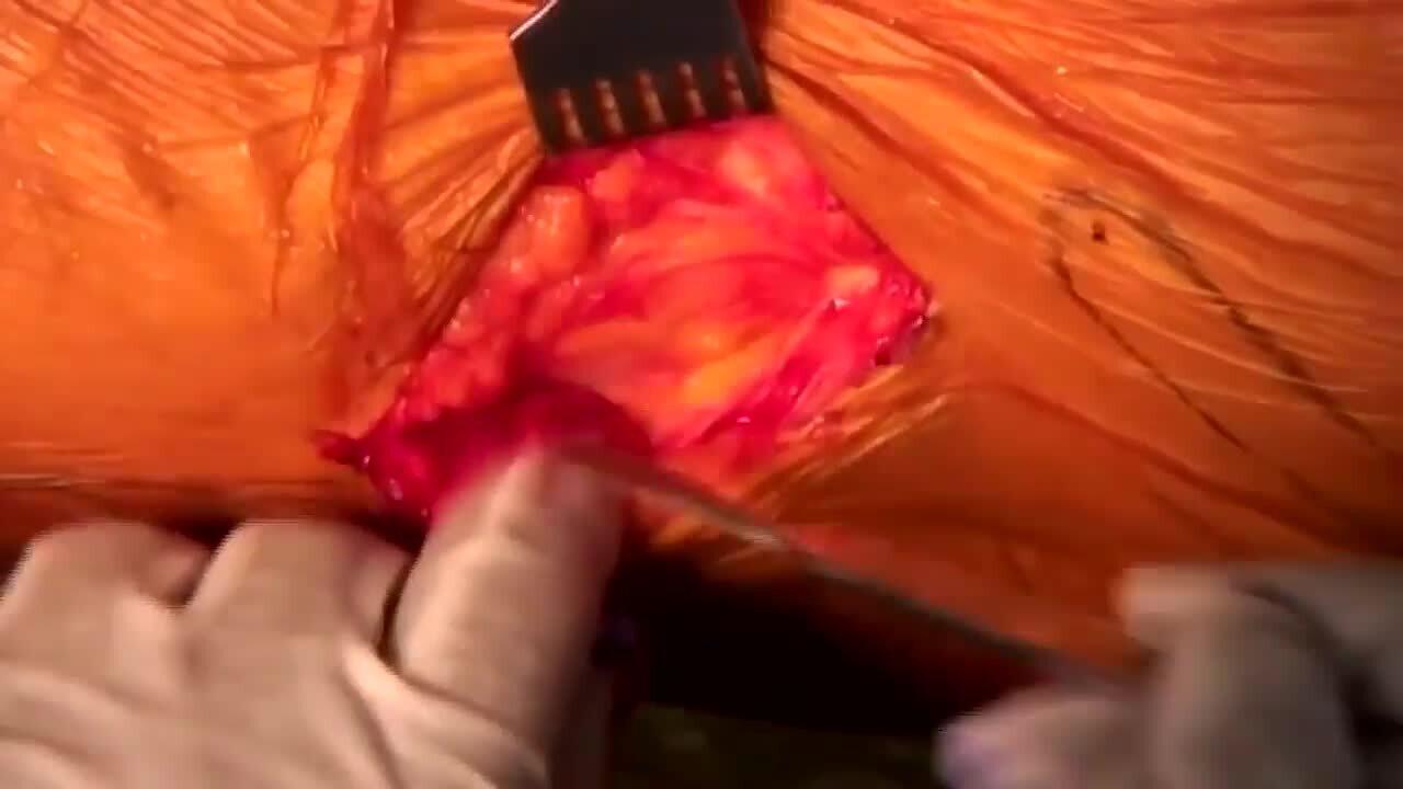 AA THA Incision and Initial Exposure Matta MD