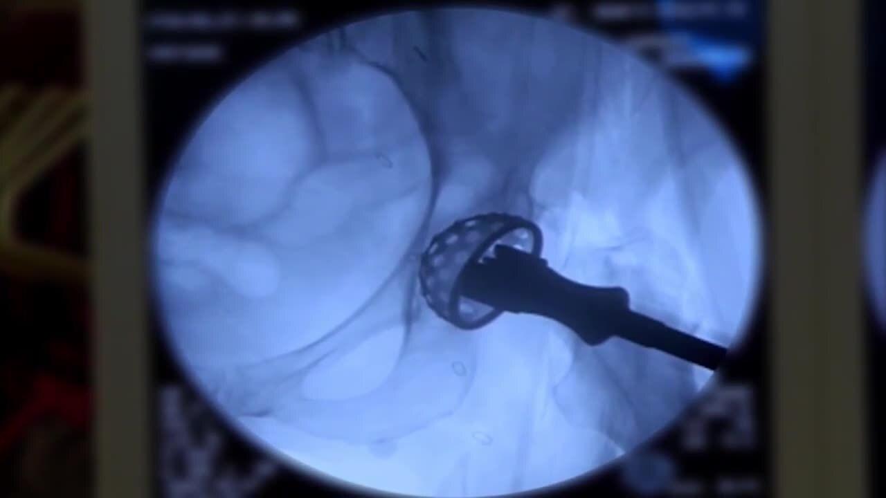AA THA Acetabular Reaming and Cup Insertion Matta MD