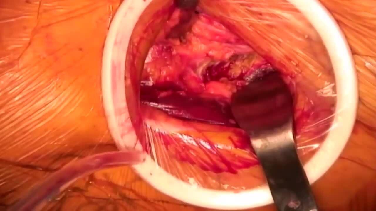 198397-211208 DSUS EMEA AA THA Capsular Exposure Matta MD