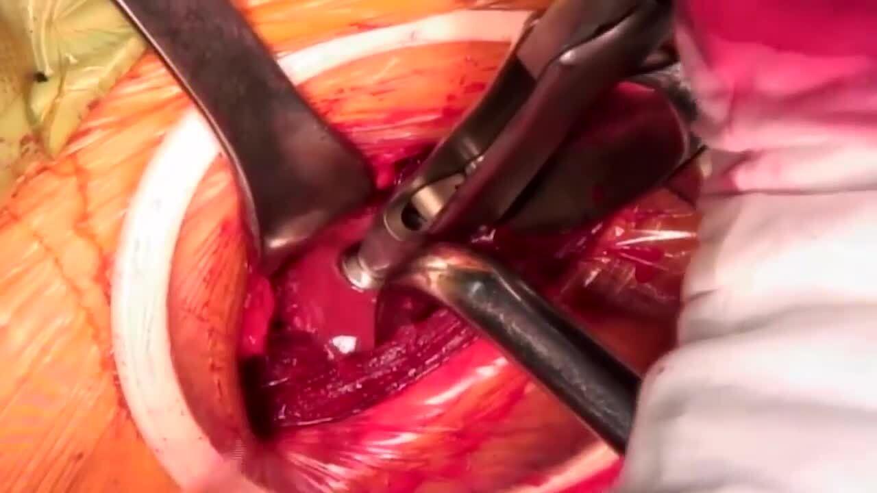 AA THA Femoral Broaching Matta MD