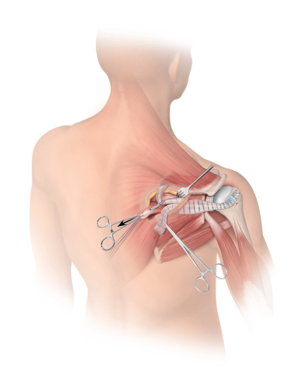 Lower Trapezius-Allograft Attachment 2