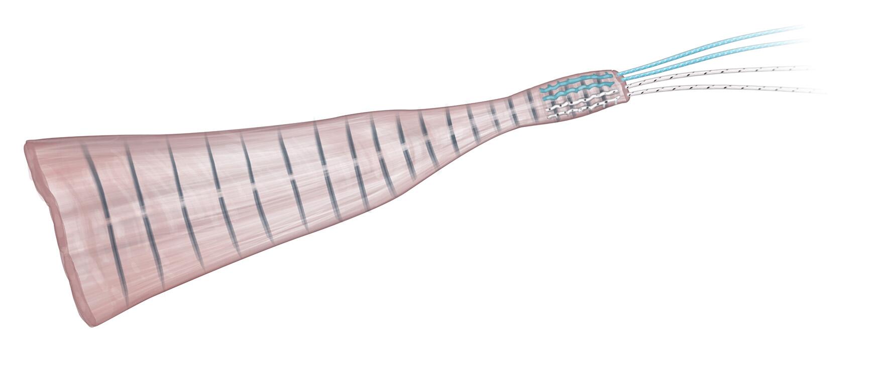 Achilles Tendon Allograft Preparation