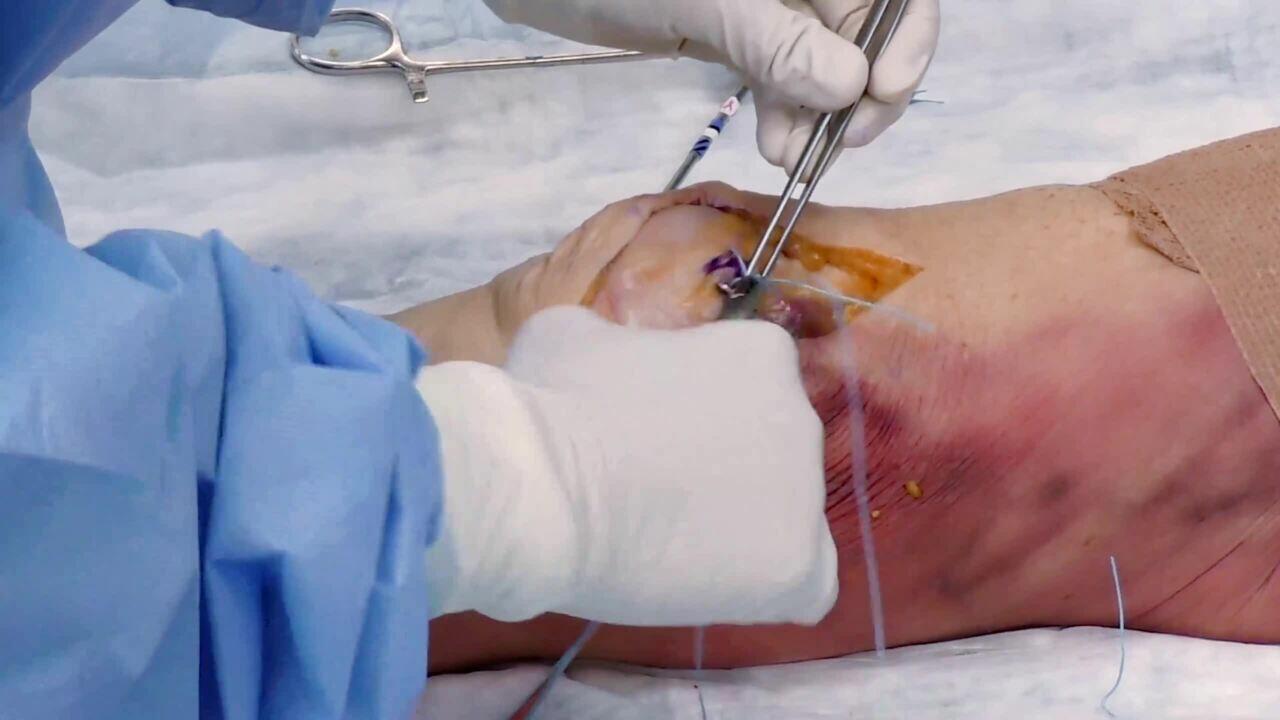 Medial Patellofemoral Ligament and Medial Quadriceps Tendon Femoral Reconstruction with TIGHT-N Anchor Featuring Dr. Tanaka