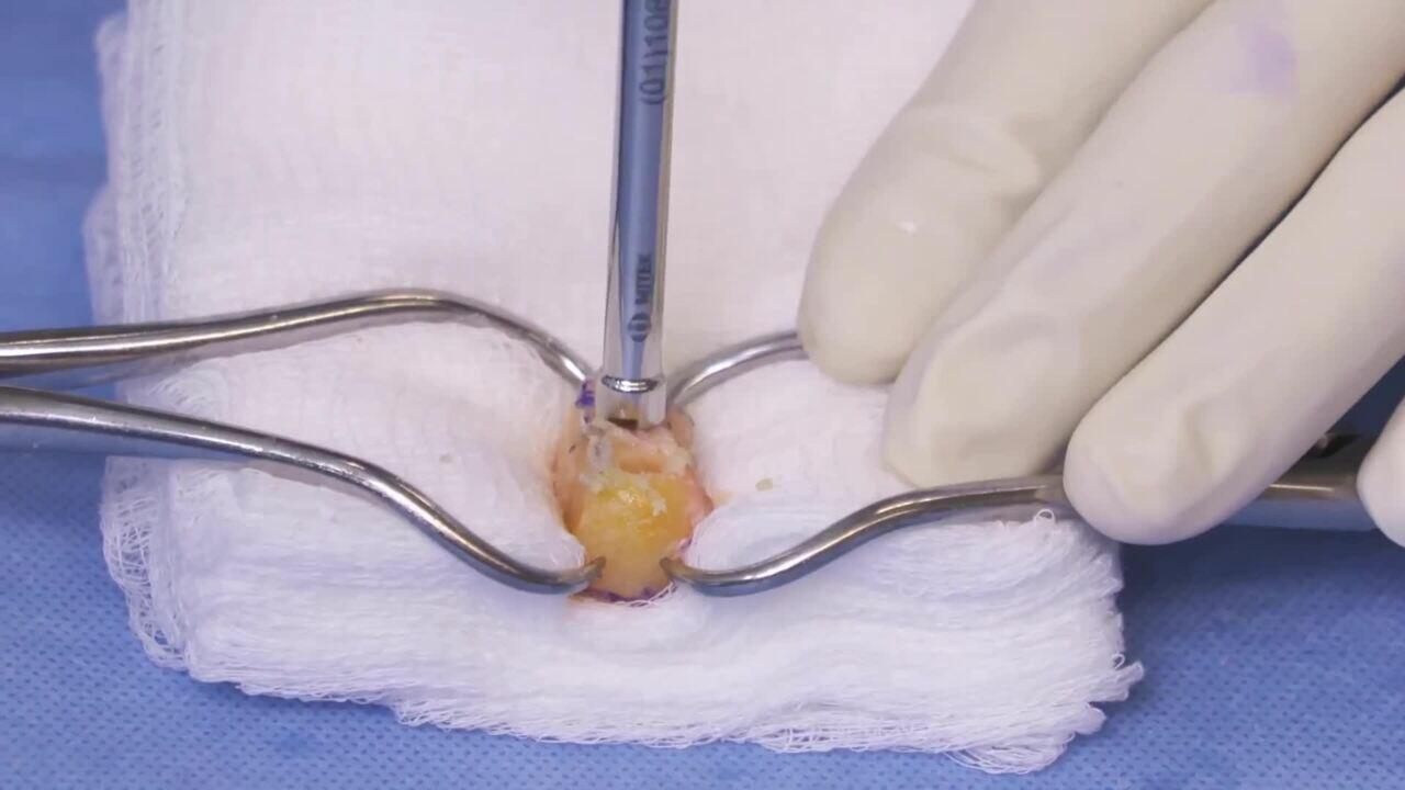 Arthroscopic Anatomic Glenoid Reconstruction Using Distal Tibial Allograft Featuring Dr. Ivan Wong