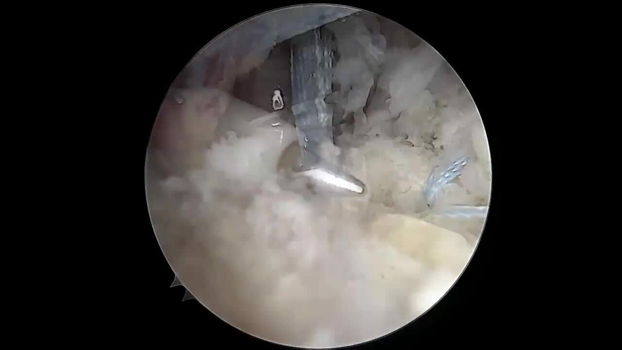 Massive RCR with Dr. Throckmorton Video
