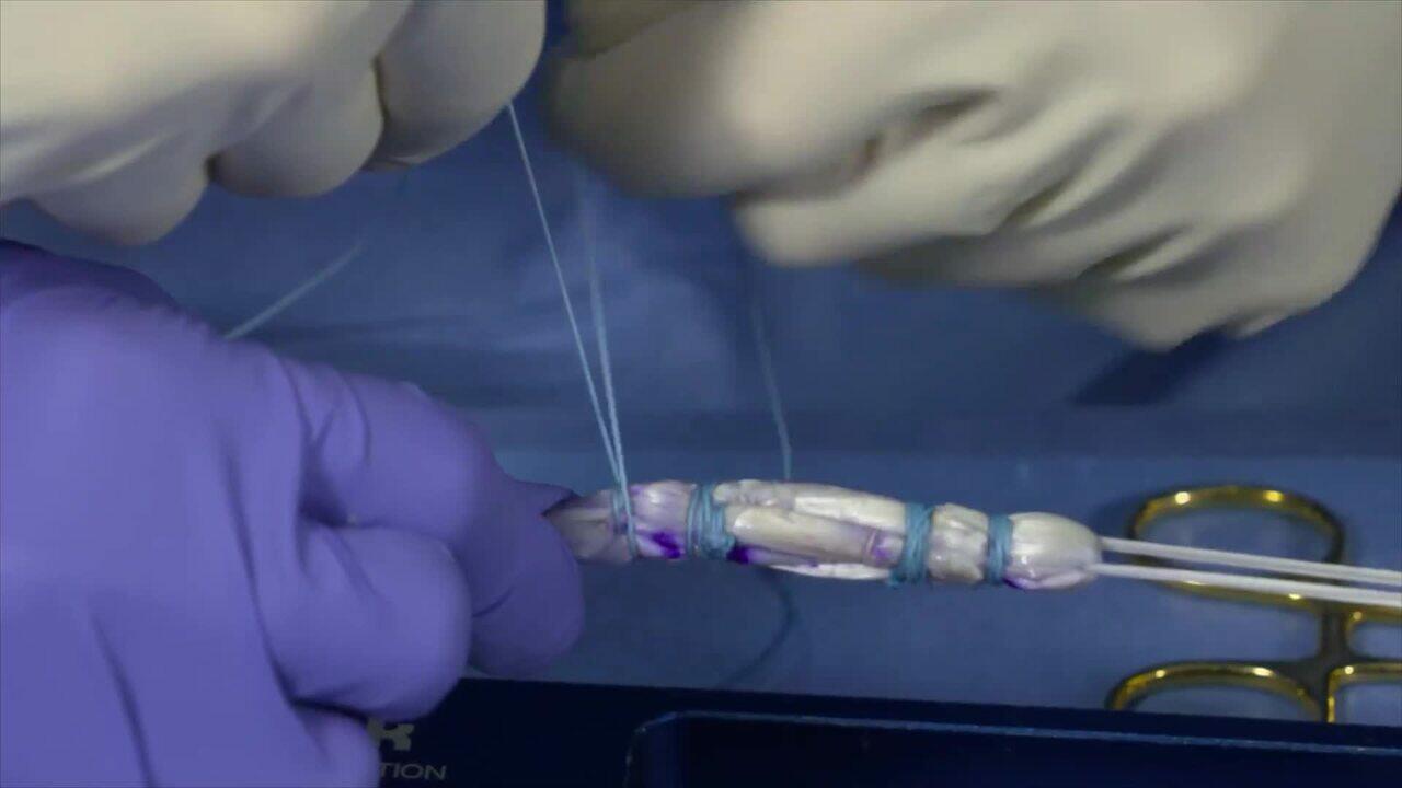 Video 1 of 2 - Dr. Gladstone’s All-Inside ACL Reconstruction Tips and Pearls: Soft Tissue Graft Prep