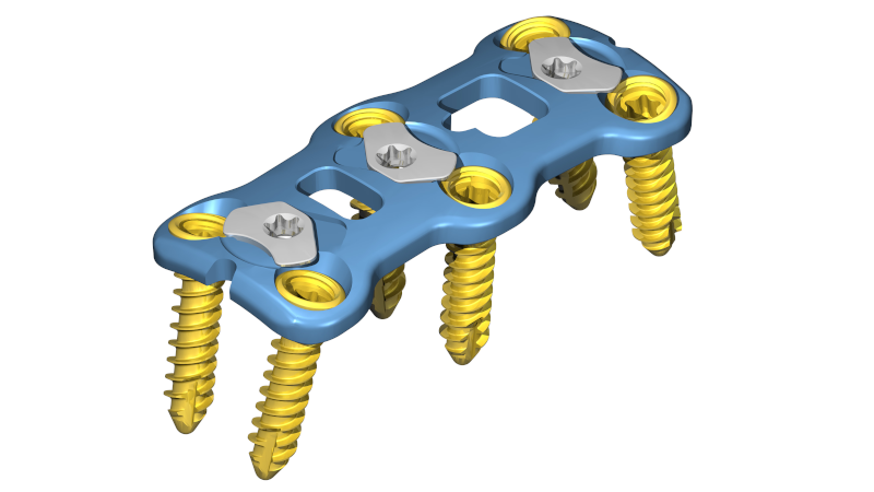 The CODA™ Anterior Cervical Plate on white background with screws inserted throughout