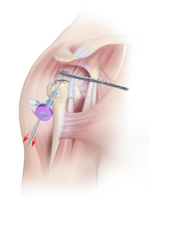 Slack is removed by pulling on the two remaining DYNACORD Sutures, pull until the tendon is positioned firmly against the bone