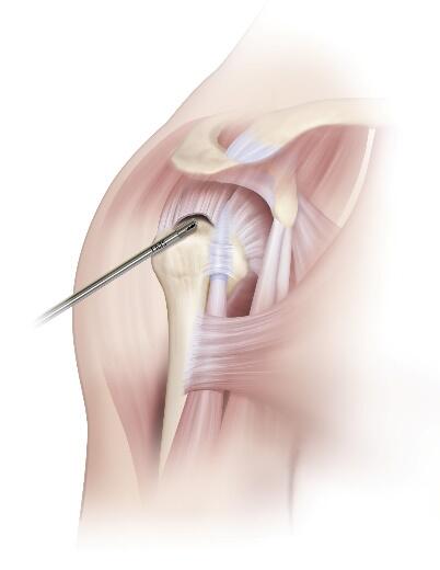 Humeral view and a standard lateral portal