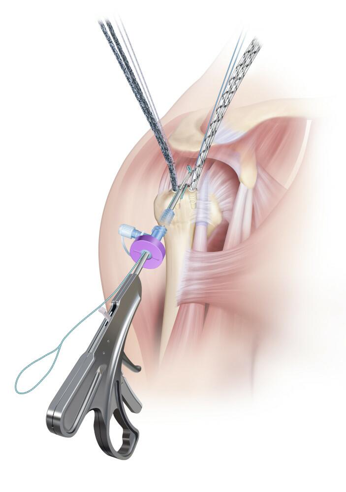 The utility suture is pulled through the posterior cuff using the EXPRESSEW™ III Flexible Suture Passer via the lateral portal