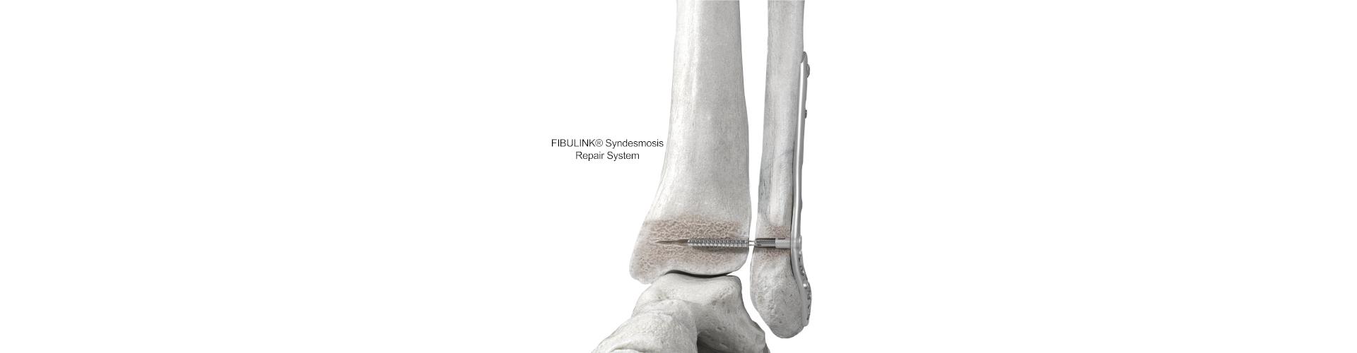 fibulink syndesmosis repair system
