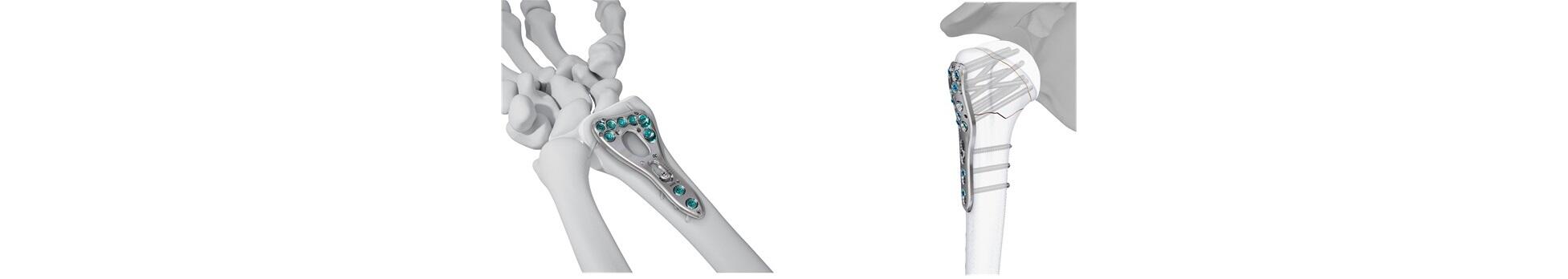 VOLT™ Wrist and Proximal Humerus Plating Systems