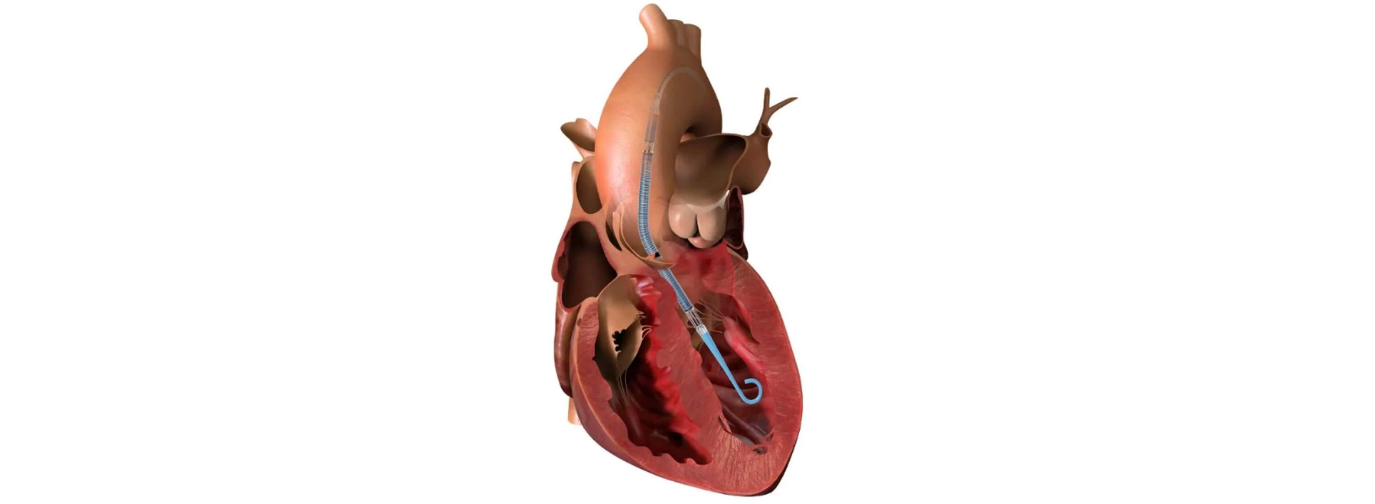 Impella CP, 임펠라, 임팰라