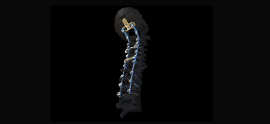 depuy synthes cervical spine system product