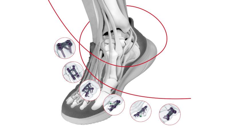 Illustrated skeletal foot wearing a shoe that is surrounded by various sketches of TriLEAP™ plates.