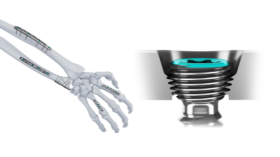 VOLT™ Variable Angle Optimized Locking Technology Plating System