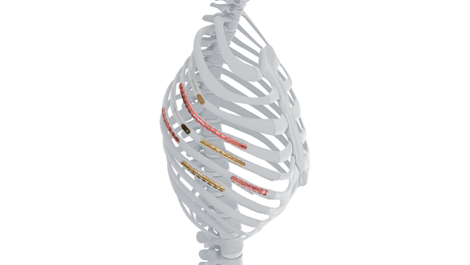 The MatrixRIB™ Fixation System offers stable fixation of normal and osteoporotic ribs combined with minimally invasive technique.