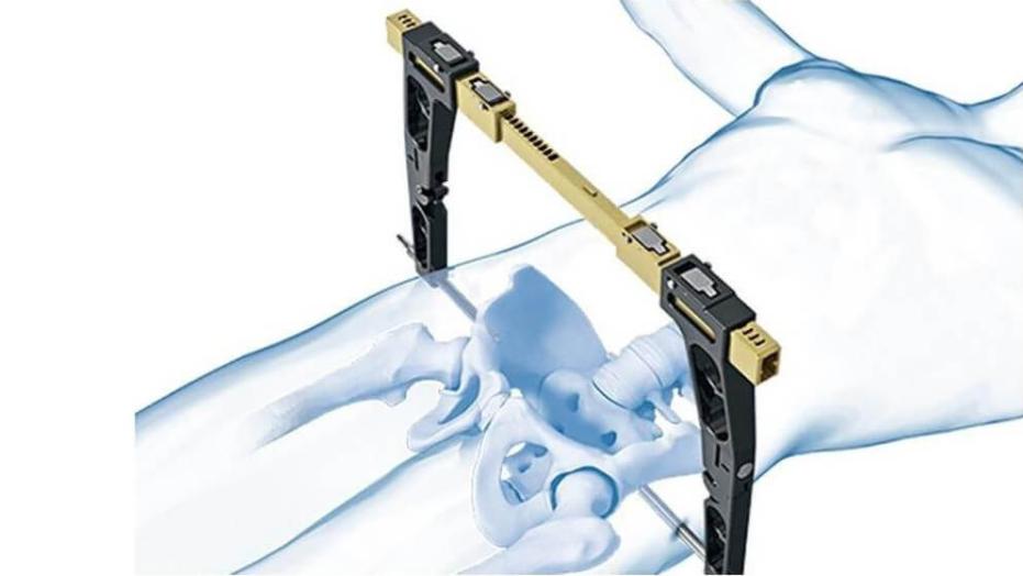 The Pelvic C-Clamp II shown in place stabilizing human pelvis