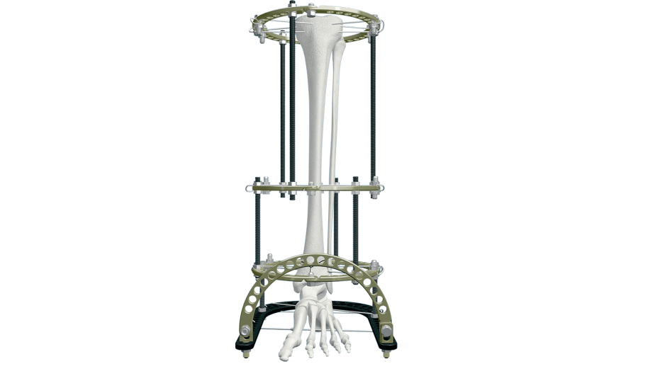 Distraction osteogenesis ring system intra-articular distal tibia frame
