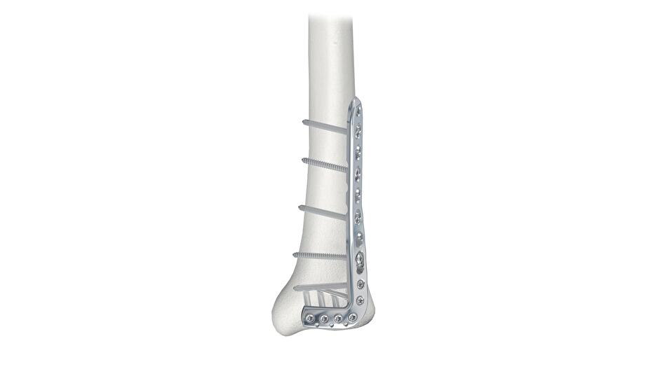 LCP Distal Tibia L-Plate attached to tibia