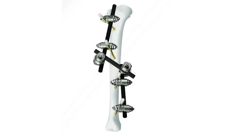 Large External Fixator attached to bone