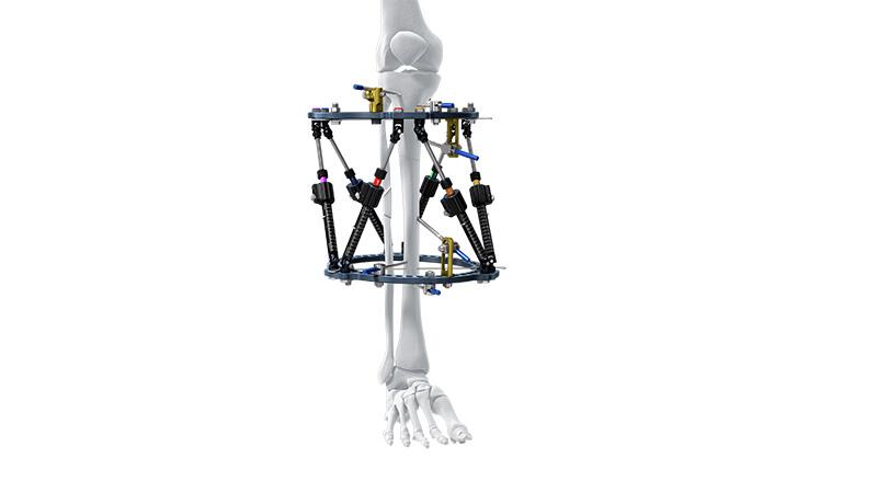 MAXFRAMETM Multi-Axial Correction System attached on bone 